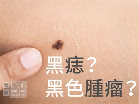 脖子長黑痣|不大驚小怪！如何辨別「黑痣」與「黑色腫瘤」？ 